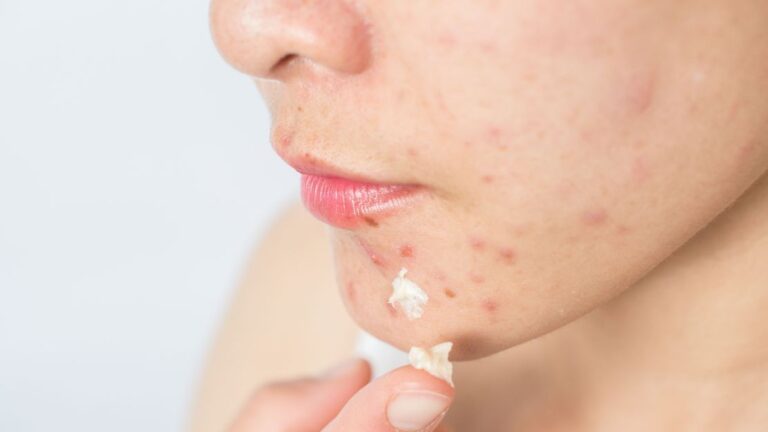 Acne: cientistas projetam “bactérias inteligentes” para tratar doença