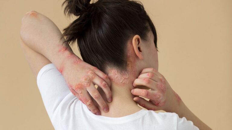 Psoríase: o que é, quais são os sintomas, tratamentos e prevenção